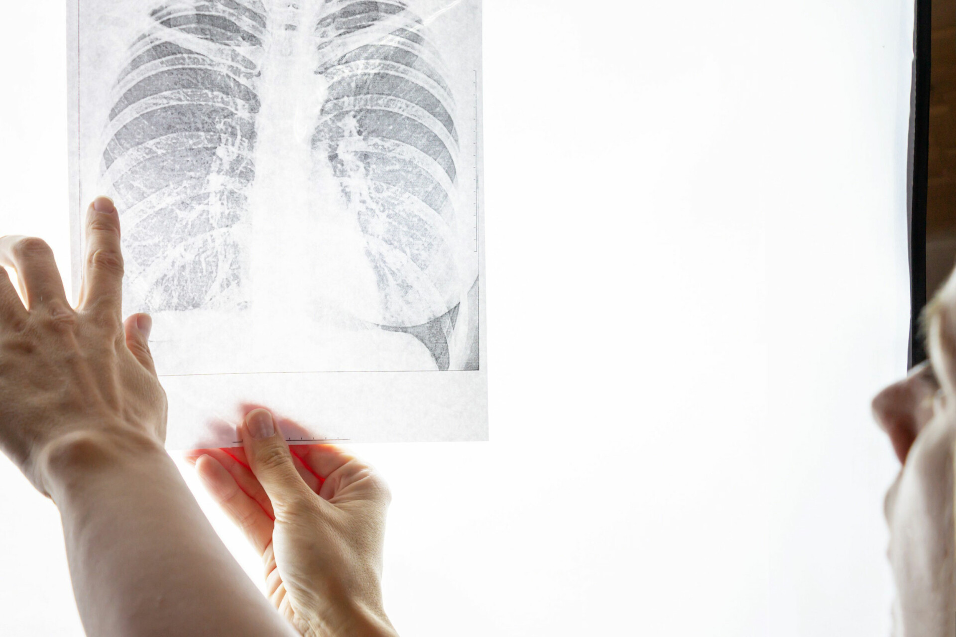 Καρκίνος του πνεύμονα © 123rf
